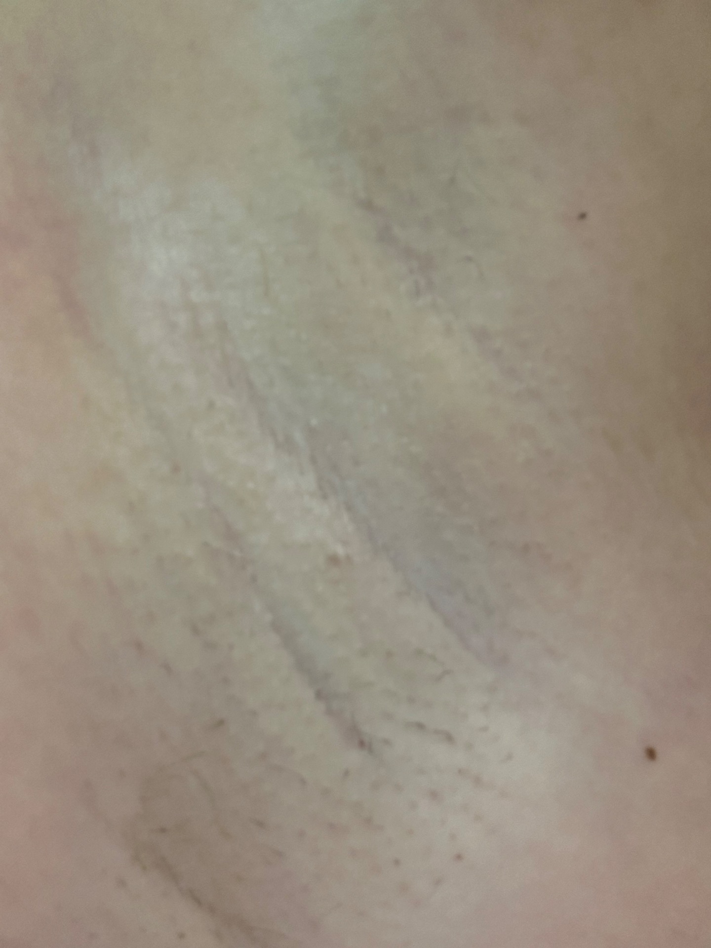 Ipl laser po 3 ošetření
